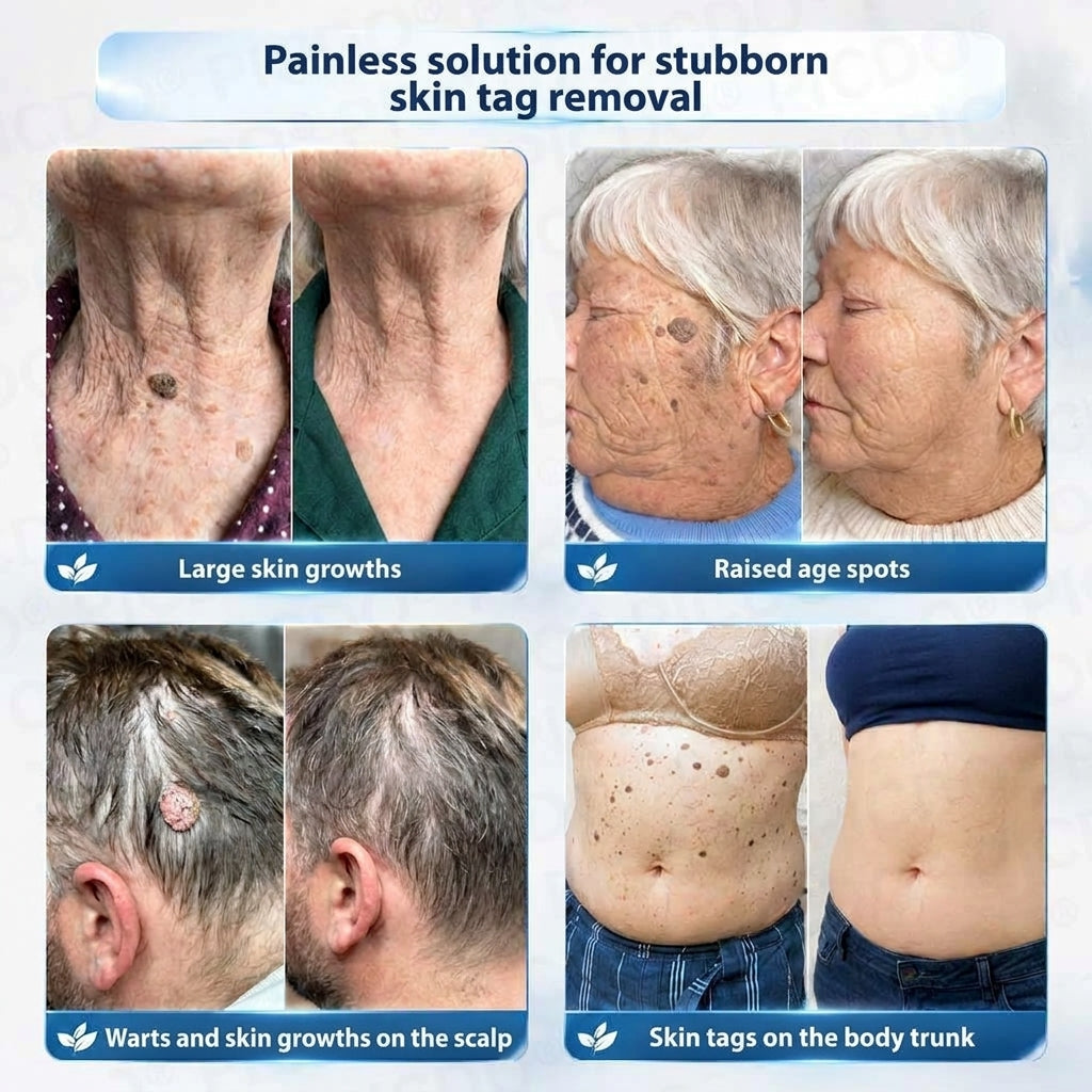 HISKIN® 10-in-1 Targeted Skin Tag & Dark Spot Cream