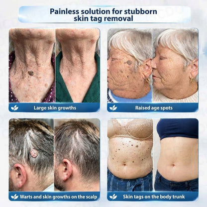 HISKIN® 10-in-1 Targeted Skin Tag & Dark Spot Cream