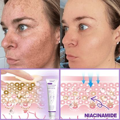 HISKIN®💟PDRN Multi-Peptide Massaging Body Roller Cream- Anti-aging, Hydrating, Skin Firming & Lifting, Skin Repair, Even Tone, Acne and Dark Spot Treatment, Wart and Mole Removal, and Psoriasis Relief