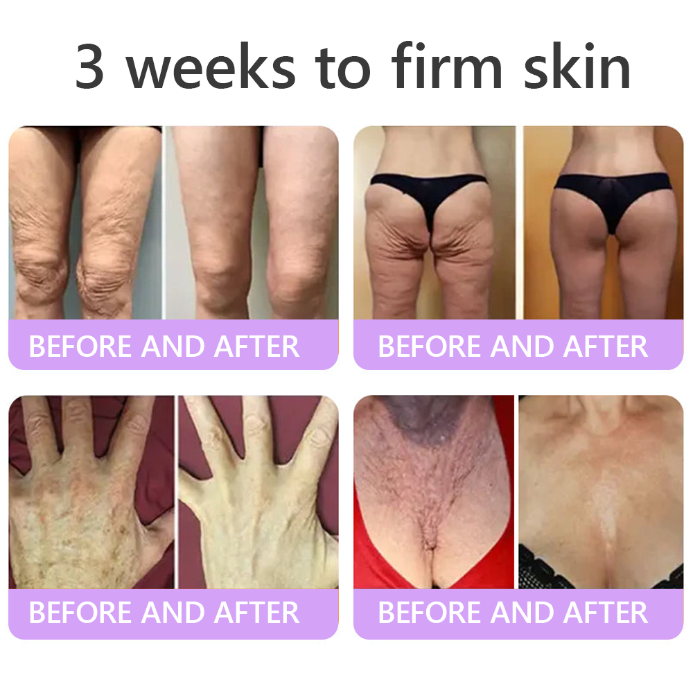 HISKIN®💟PDRN Multi-Peptide Massaging Body Roller Cream- Anti-aging, Hydrating, Skin Firming & Lifting, Skin Repair, Even Tone, Acne and Dark Spot Treatment, Wart and Mole Removal, and Psoriasis Relief