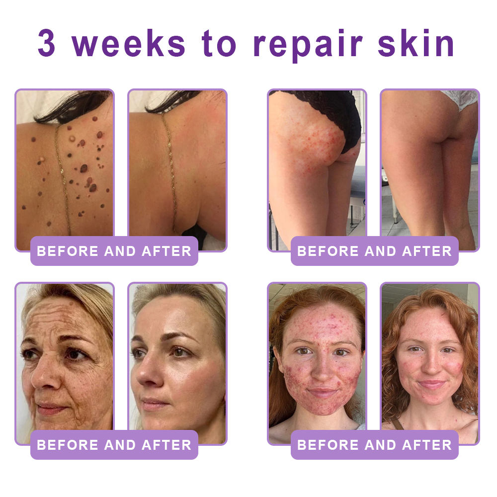 HISKIN®💟PDRN Multi-Peptide Massaging Body Roller Cream- Anti-aging, Hydrating, Skin Firming & Lifting, Skin Repair, Even Tone, Acne and Dark Spot Treatment, Wart and Mole Removal, and Psoriasis Relief
