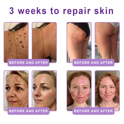 HISKIN®💟PDRN Multi-Peptide Massaging Body Roller Cream- Anti-aging, Hydrating, Skin Firming & Lifting, Skin Repair, Even Tone, Acne and Dark Spot Treatment, Wart and Mole Removal, and Psoriasis Relief