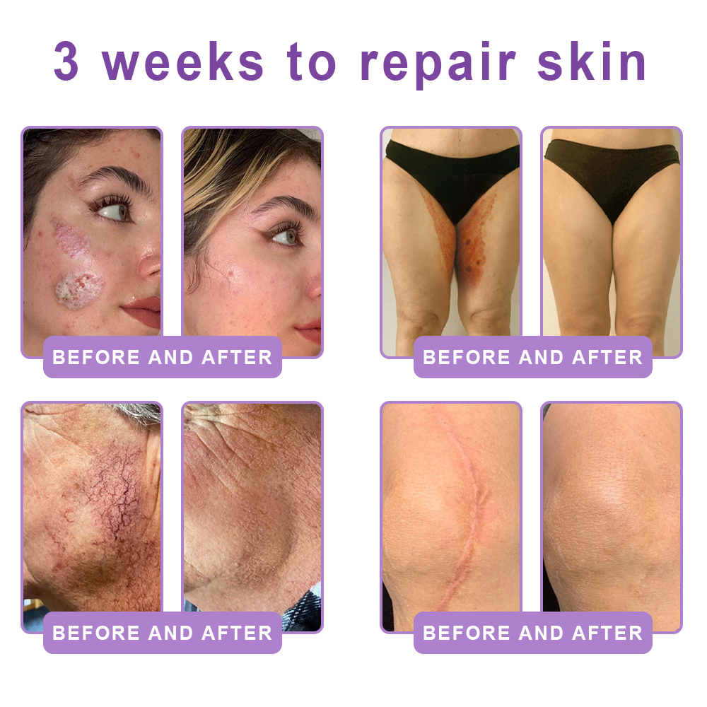 HISKIN®💟PDRN Multi-Peptide Massaging Body Roller Cream- Anti-aging, Hydrating, Skin Firming & Lifting, Skin Repair, Even Tone, Acne and Dark Spot Treatment, Wart and Mole Removal, and Psoriasis Relief