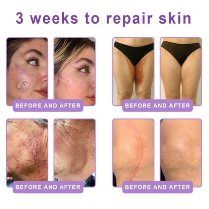 HISKIN®💟PDRN Multi-Peptide Massaging Body Roller Cream- Anti-aging, Hydrating, Skin Firming & Lifting, Skin Repair, Even Tone, Acne and Dark Spot Treatment, Wart and Mole Removal, and Psoriasis Relief