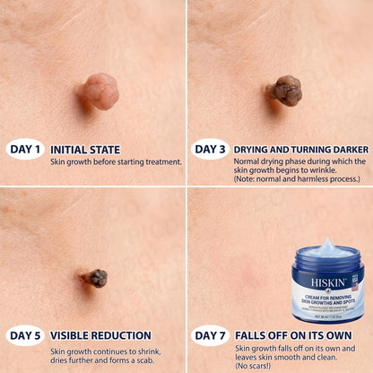 HISKIN® 10-in-1 Targeted Skin Tag & Dark Spot Cream